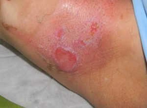 Heridas que no cicatrizan: síntomas de la EAP
